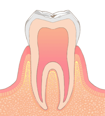 C0（初期虫歯）