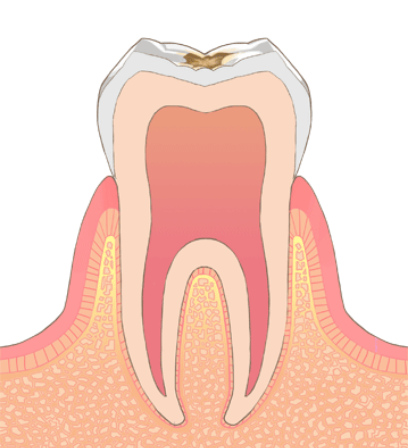 C1（エナメル質う蝕）