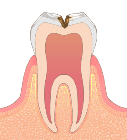 C2（象牙質う蝕）