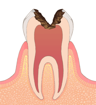 C3（神経までのう蝕）