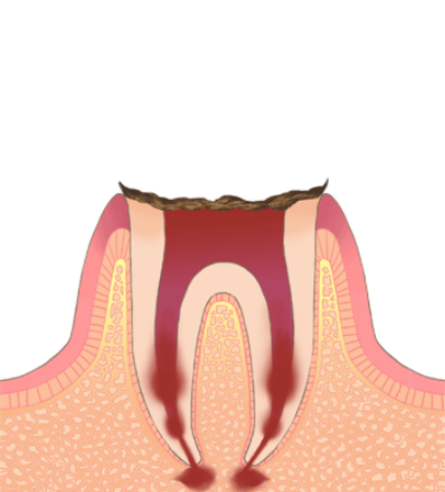 C4（歯の根まで進行）
